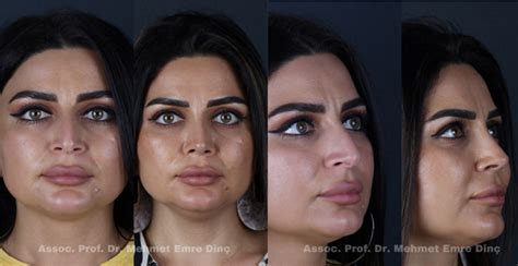 Mehmet</b> Emre Dinç, a surgeon and ENT specialist with over 15 years of practice. . Dr mehmet rhinoplasty